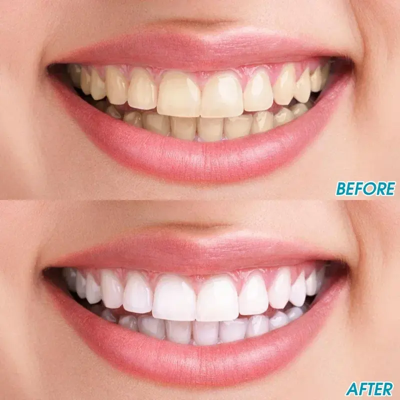 WhiteWand™ Precision Stain Eraser - Instant Teeth Whitening Brush